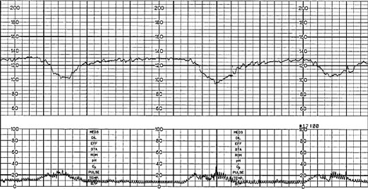 fetal heart tracing